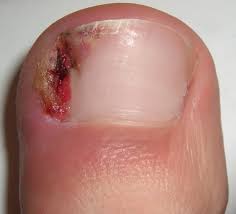 How to Treat an Ingrown Toenails